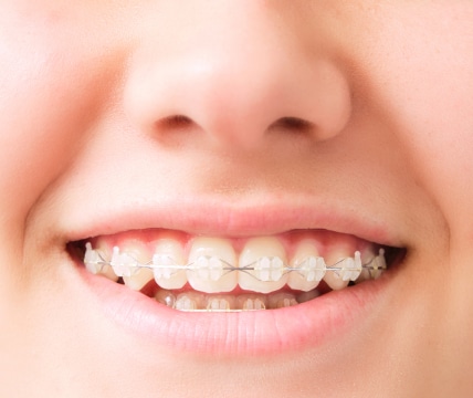 A close-up of a person smiling with ceramic braces on their teeth, showing a clear, white appearance of the orthodontic treatment.
