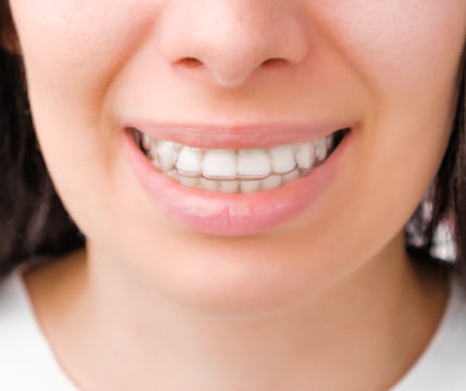 A close-up of a person smiling, showing teeth with clear braces. The background is out of focus and not discernible.