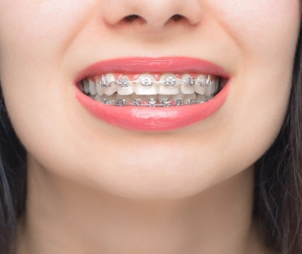 A close-up of a person's mouth with pink lipstick, showing teeth with braces, and a bright smile. No landmarks or historical buildings visible.